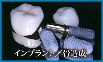 インプラント/骨造成